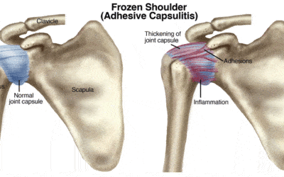 Frozen Shoulder (Adhesive Capsulitis): Alternatives To Surgery