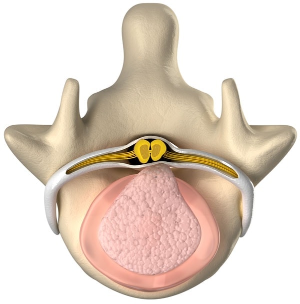 Bulging or Herniated Disc Treatment